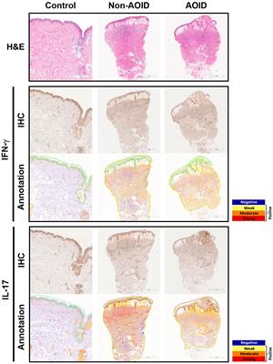 Comparative immunohistochemical analysis of inflammatory cytokines in distinct subtypes of Sweet syndrome